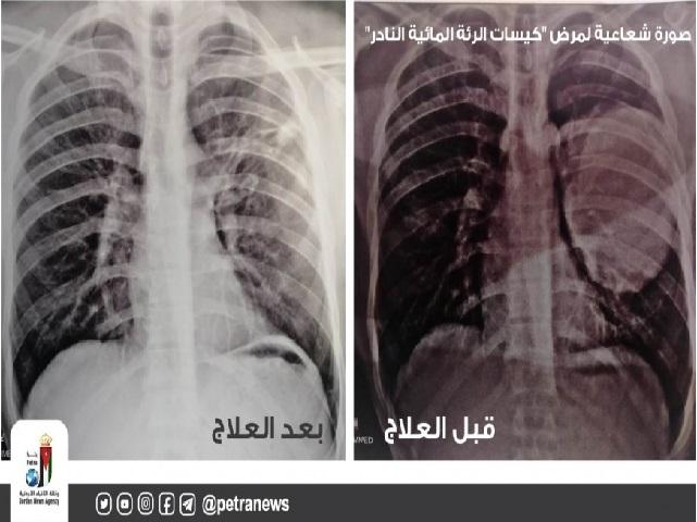 في يومها العالمي الأمراض النادرة بين العلاج وصدمة التعايش