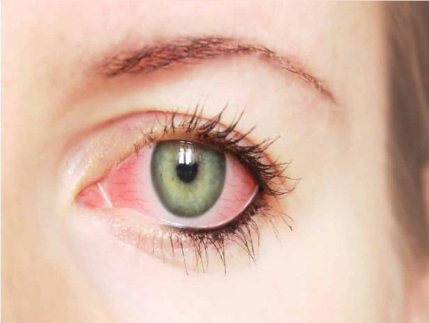 مجموعة أمراض قد تسبب العمى تعرّف على الجلوكوما